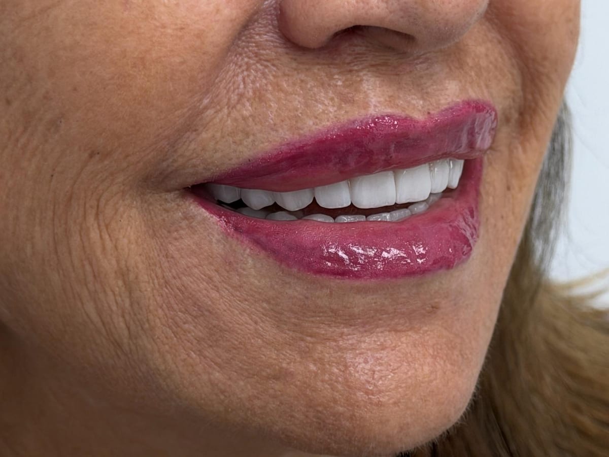Carillas dentales ilumine — salud & medicina en Valencia