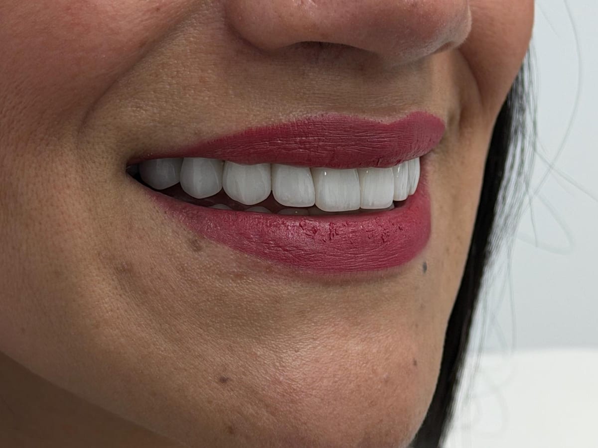 Carillas dentales ilumine — foto 3